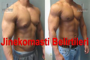 jinekomasti nedir